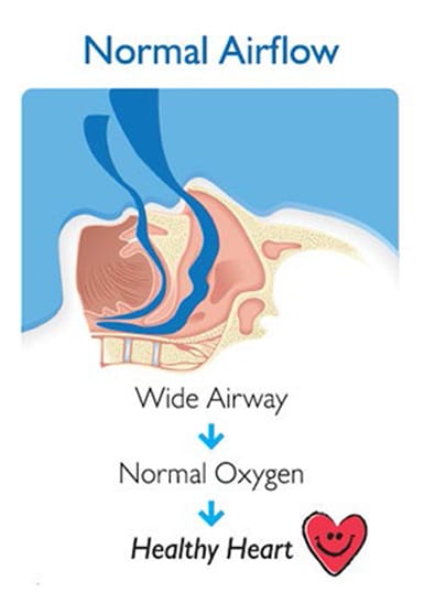 Normal-Airflow-Healthy-Heart