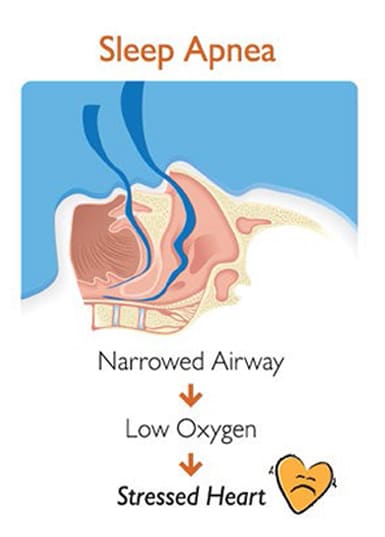 Sleep-Apnea-Stressed-Heart