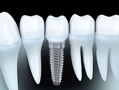 dental-implant-illustration