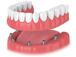 dental-implant-illustration2