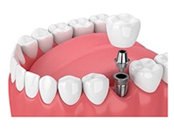 dental-implant-illustration4