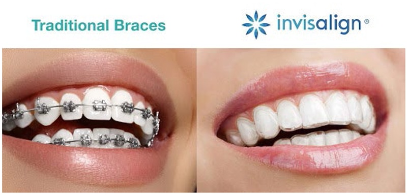 Clear Braces Clear Aligners Invisalign vs Traditional Braces