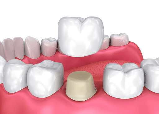Northtown Dental -Crowns in North York